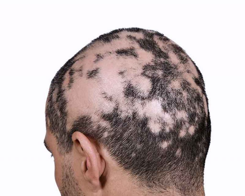 alopecia-areata-1024x820